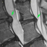 Лечение рецидива грыжи после операции
