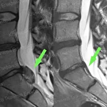 Лечение рецидива грыжи после операции