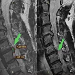 Лечение рецидива грыжи после операции