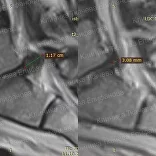 Лечение рецидива грыжи после операции